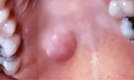 <p>How would you treat polymorphous adenocarcinoma?</p>