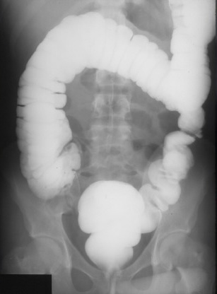 <p>What is this x-ray demonstrating?</p>