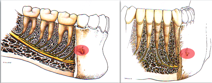 <p>Mental nerve as it exits mental foramen (between apices of the 1st and 2nd premolar)</p>