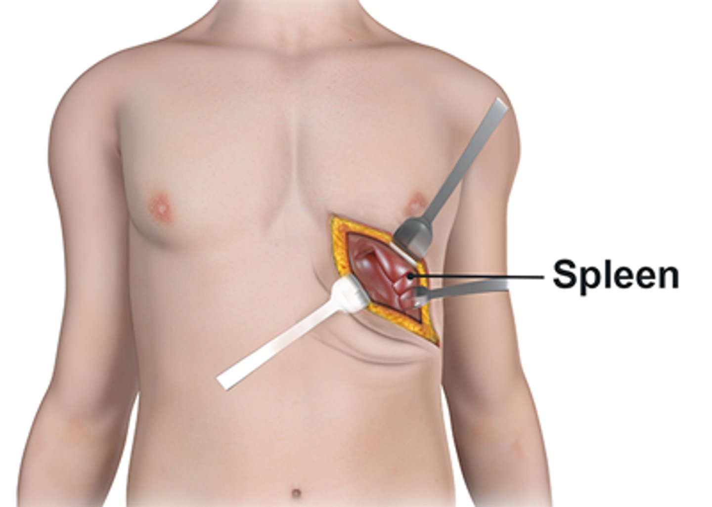 <p>1/3 of platelets are stored in the spleen --> removal of spleen --> platelets have NO HOME ANYMORE!! --> high platelet count in blood --> thrombocytosis</p>