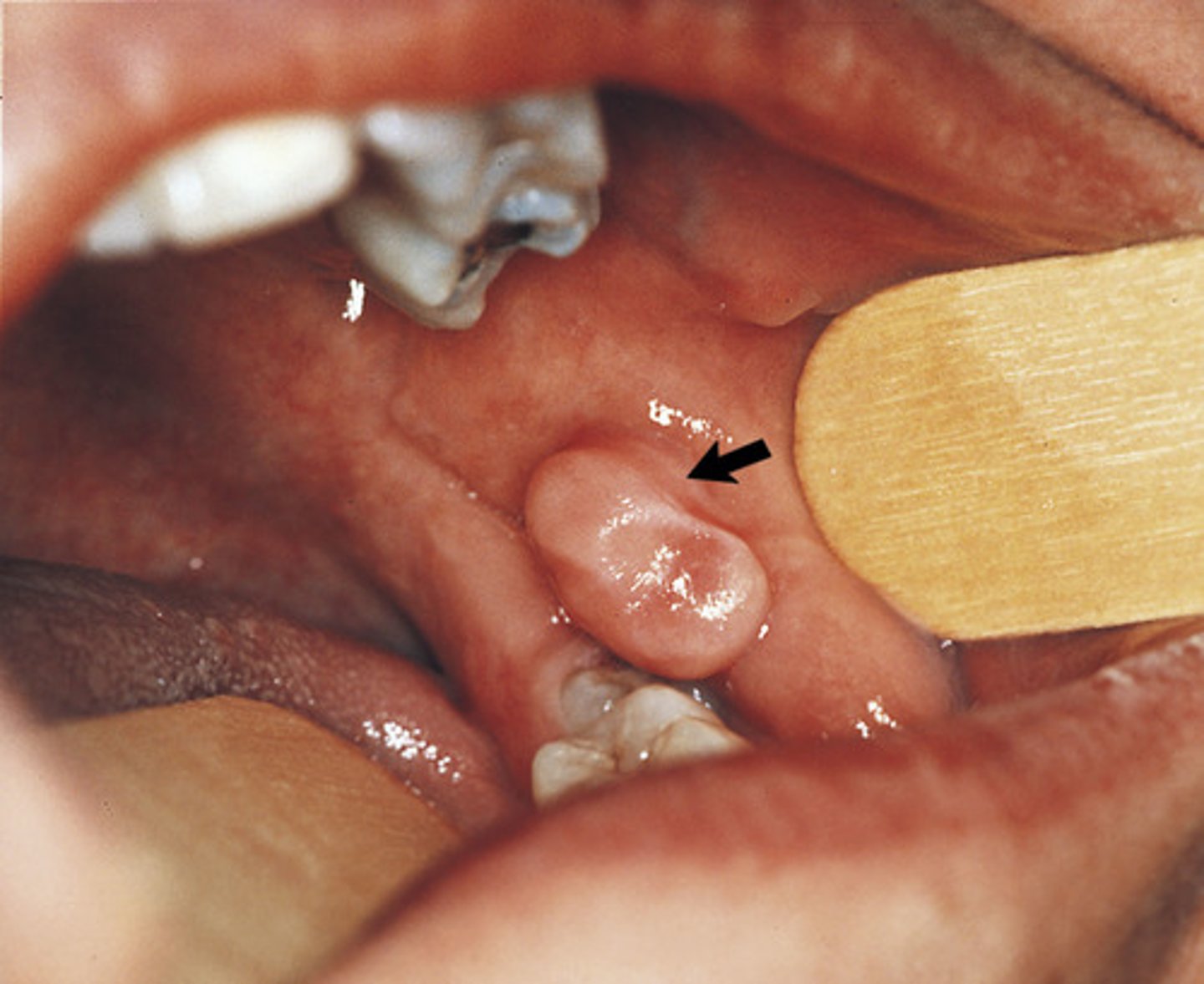 <p>The base of attachment for this lesion is:</p>