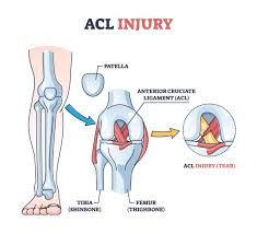 <p>anterior cruciate ligament </p>