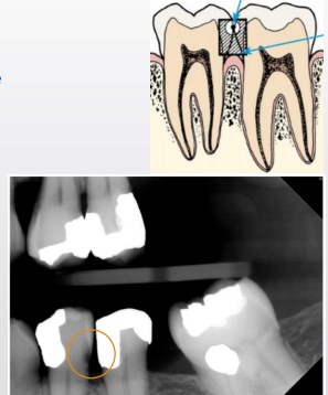<p>in proximal caries, is between the contact point of the teeth and gingival margins </p>