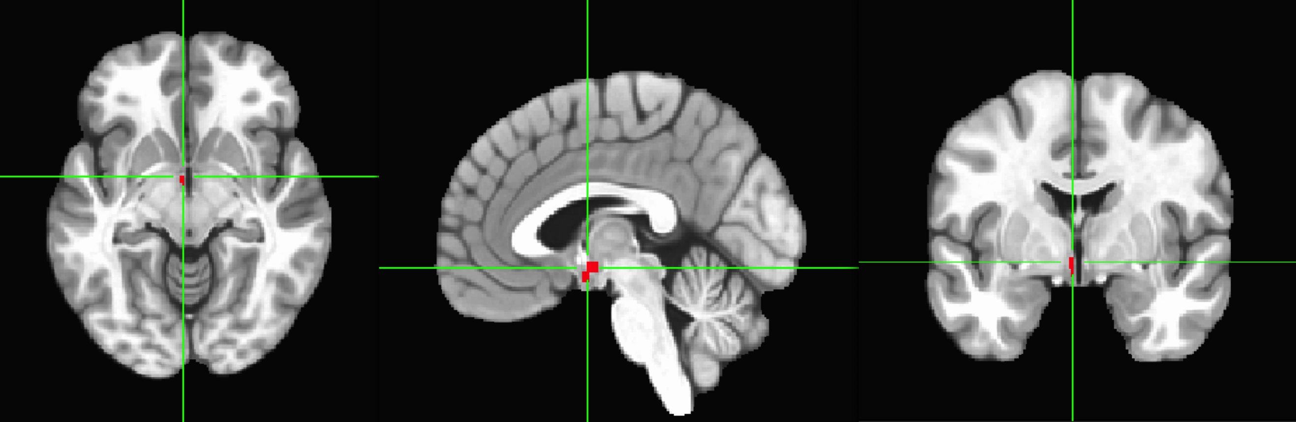 <p>left and right hemisphere that are both important for motivating behaviors. This is part of the Diencephalon</p>