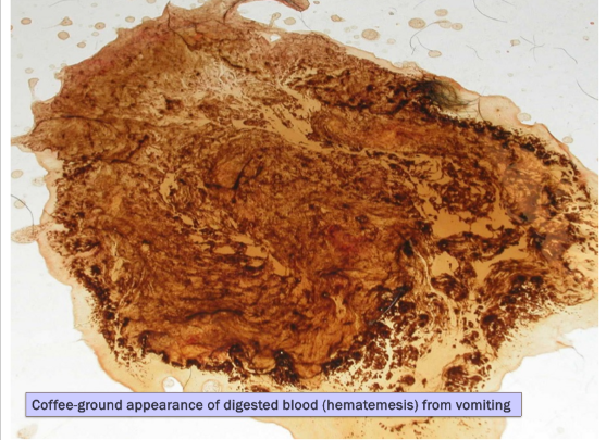 <ul><li><p>Forceful expulsion of gastric and intestinal contents through the mouth (CNS reflex) </p></li><li><p>dysphagia - absent </p></li><li><p>ability to drink - normal </p></li><li><p>attempts to swallow - single </p></li><li><p>abdominal contractions - <strong>present </strong></p></li><li><p>time after eating - variable </p></li><li><p>food - <strong>partially digested; may be undigested </strong></p></li><li><p>bile (yellow) - <strong>present </strong></p></li><li><p>blood - <strong>dark brown “coffee grounds” </strong></p></li><li><p>hair, plant, other - possible </p></li></ul><p>complications: </p><ul><li><p>aspiration pneumonia - possible </p></li><li><p>fluid/electrolyte imbalance - <strong>common </strong></p></li></ul><p></p>