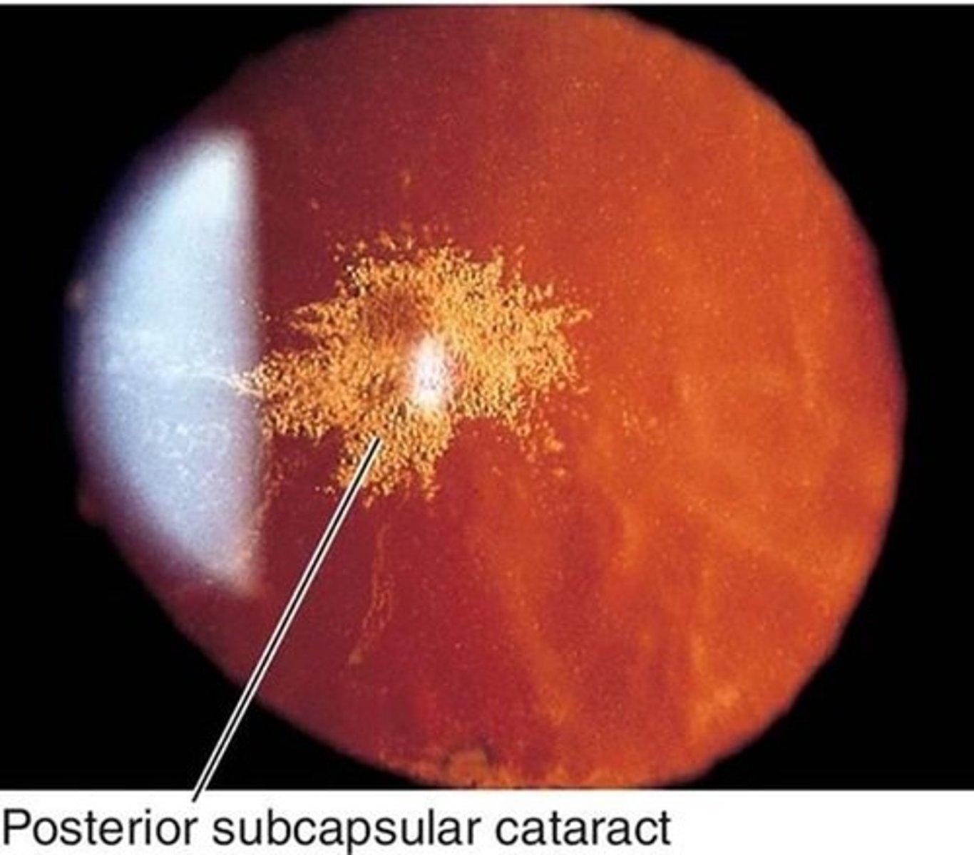 <p>A type of cataract that forms at the back of the lens, often affecting reading vision and causing glare.</p>