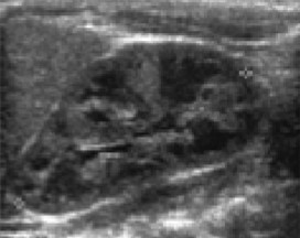 <p>Is the kidney imaged from an adult, child, neonate, or fetus?</p>