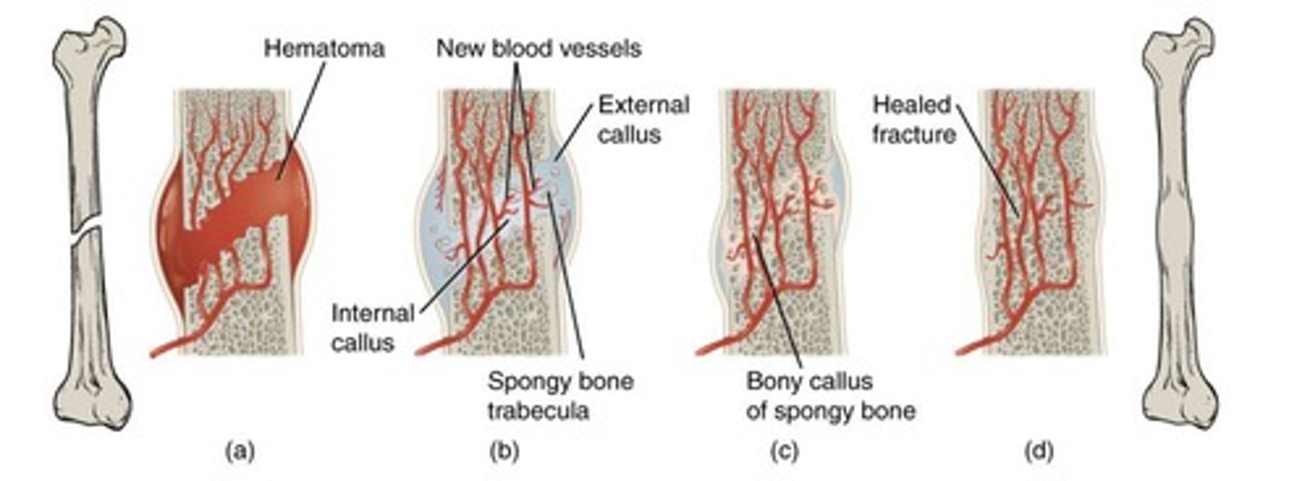 <p>Hematoma formation.</p>