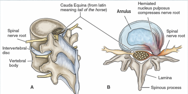 <p><span>Disorder that results from the breakdown of intervertebral discs in spine due to aging or injury, causing pain, stiffening or decreased mobility&nbsp;</span></p>