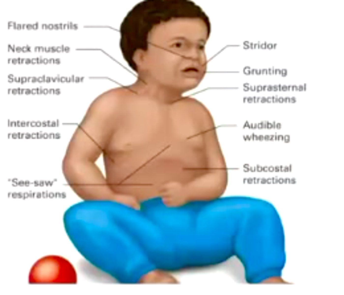 <p>nasal flaring, retractions, grunting, stridor, decreased muscle tone, altered mental status, decreased heart rate, decreased cap refill time</p>