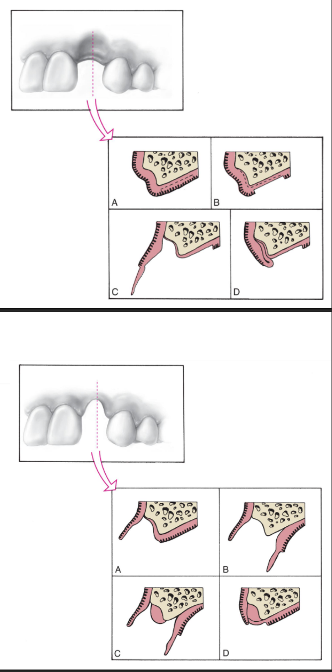 <ul><li><p>roll technique (top pic)</p></li><li><p>pouch technique (bottom pic) </p></li></ul><p></p>