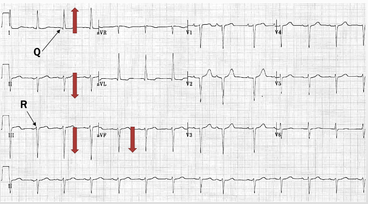 <p>LAD, Q wave in lead I + R wave in lead III, mostly - lead II &amp; III</p>