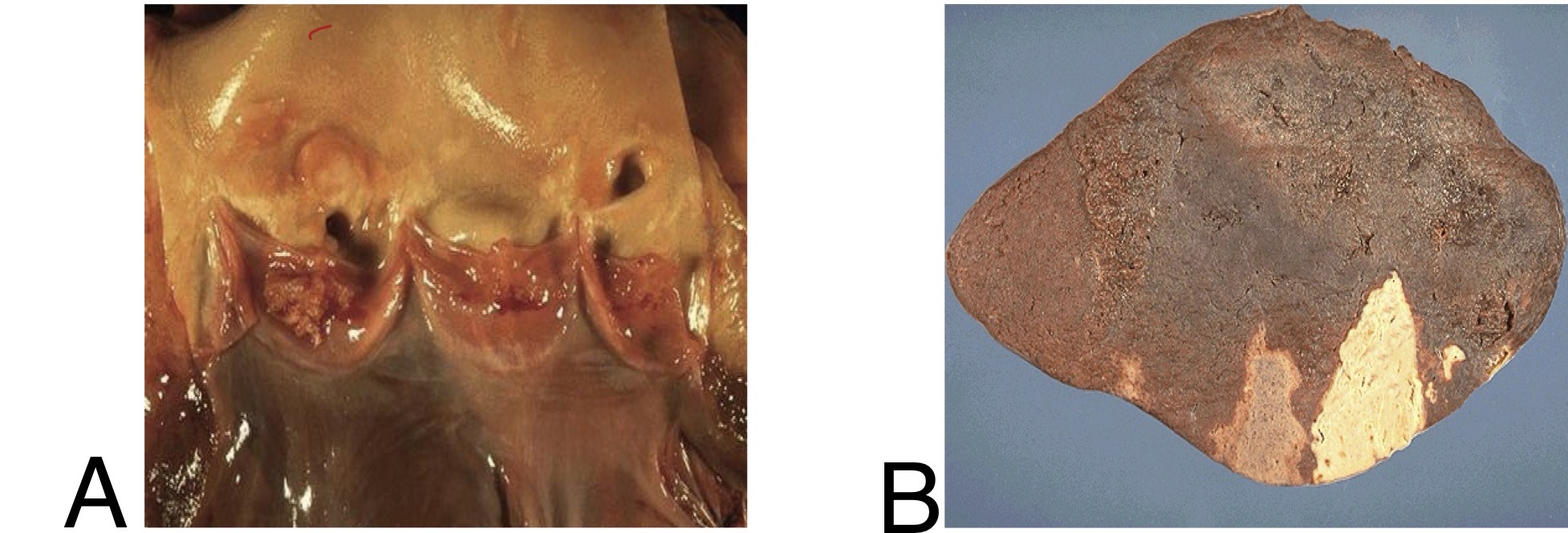 <p><span>Given that under microscopic examination of the lesion in A, there was no evidence of inflammation or bacterial colonization:</span></p><p><span>1. Describe the shown lesion in A. </span></p><p><span>2. Identify the condition in A? </span></p><p><span>3. Identify the complication happened in B? What is the potential cause of such a finding in the context of A?&nbsp; </span></p>
