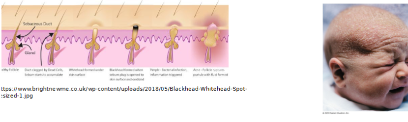 <ul><li><p>usually an infectious inflammation of sebaceous glands, resulting in pimples (pustules or cysts)</p></li><li><p>whiteheads, <strong>or closed comedones,</strong> are blocked sebaceous glands</p><ul><li><p>if secretion is oxidized, whitehead becomes blackhead, AKA open comedones</p></li></ul></li><li><p>overactive sebaceous glands in infants can cause seborrhea, known as ‘cradle cap’</p><ul><li><p>begin as pink, raised lesions on scalp that turn yellow/brown and slough off</p></li></ul></li></ul><p></p>