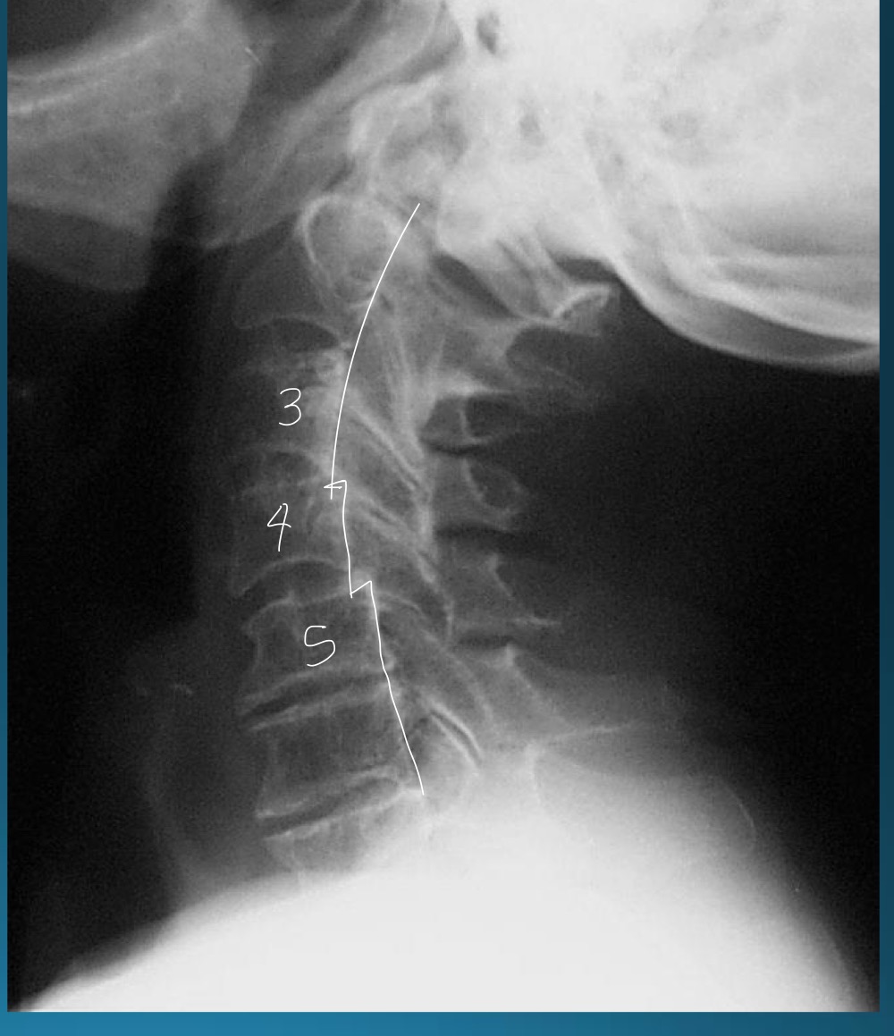 <p>RA impact on cervical arthrosis has what characteristics?</p>