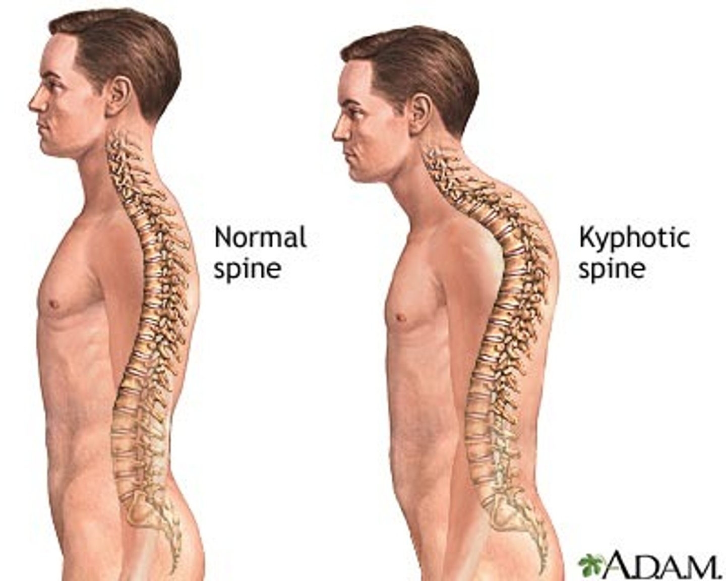 <p>Abnormally rounded upper back</p><p>More than 50 degrees of curvature</p>