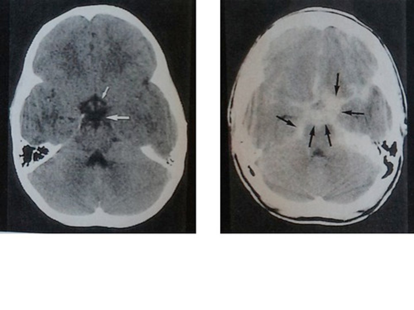 <p>Subarachnoid hemorrhage is seen as blood in the ventricular cisterns, interhemispheric fissures and within the sulci.</p>