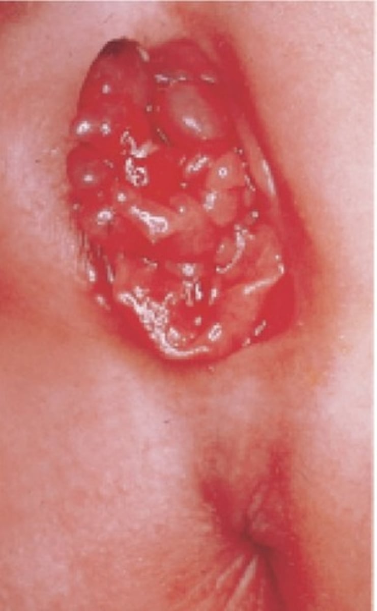 <p>Most common malignity lower urinary tract/uterine/vaginal mass in pediatric patients</p><p>Cluster of cysts protruding from vagina</p><p>Homogenous mass filling vaginal cavity</p>