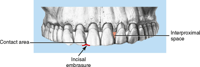 <p>Interproximal spaces</p>