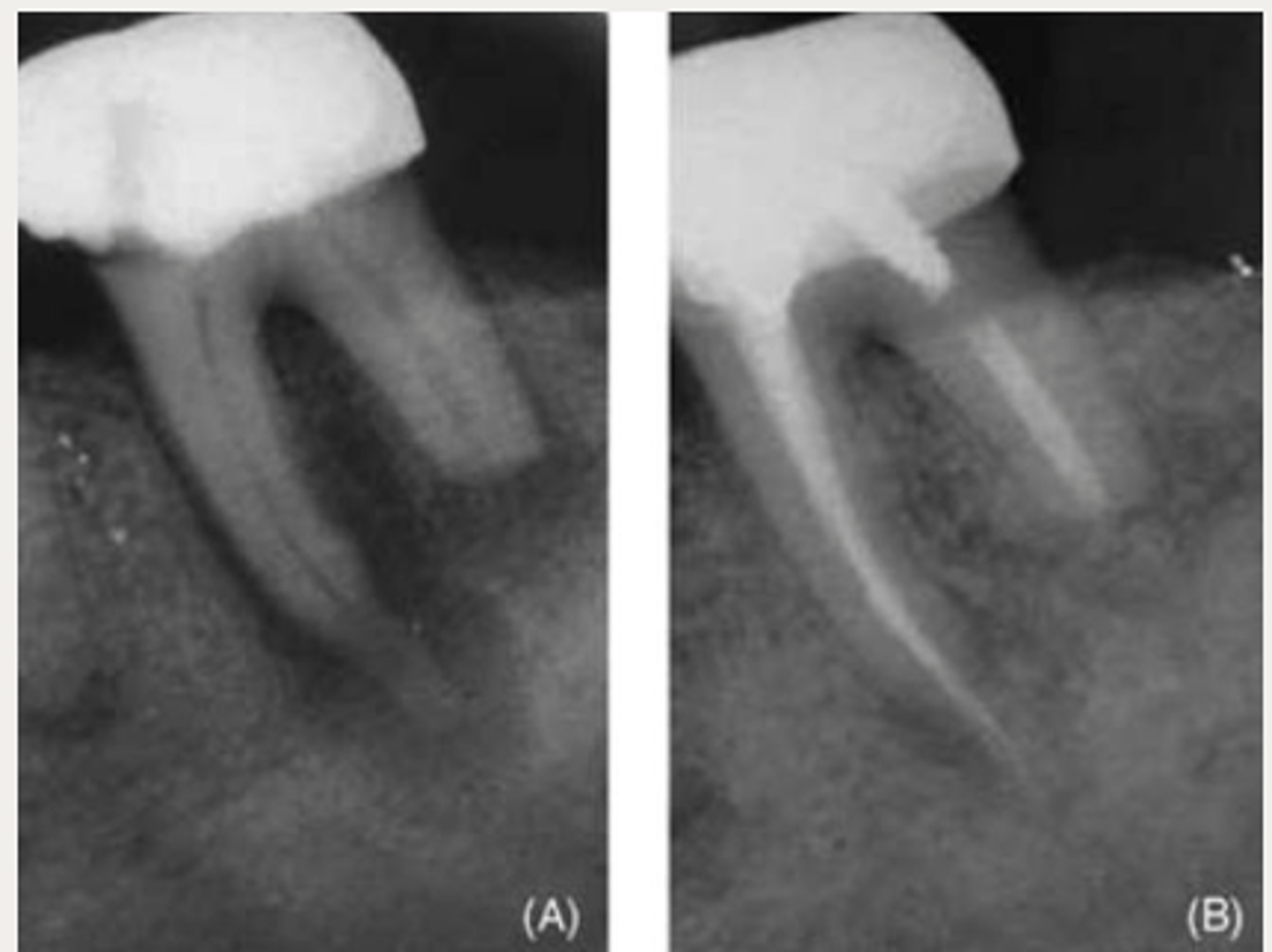 <p>What is the prognosis of external inflammatory resorption (EIR)?</p>