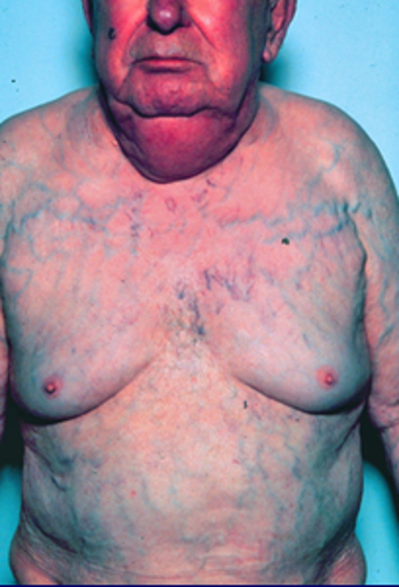 <p>most of the time, this will be a prepsenting symptom of an undiagnosed cancer</p>