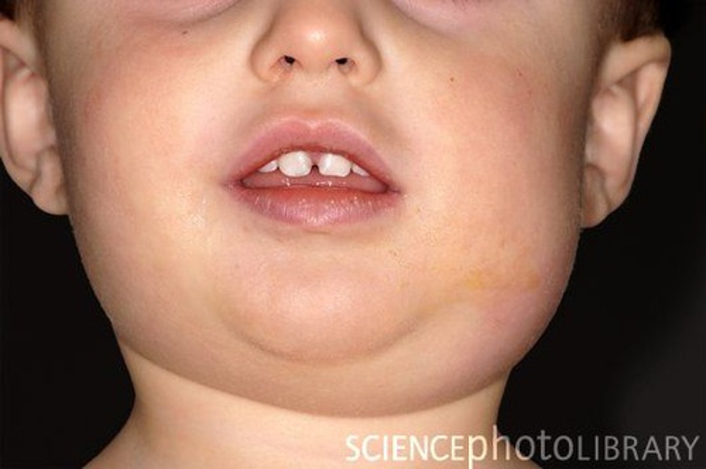 <p>inflammation of salivary gland due to decreased salivary flow from staph infection resulting in ear pain and fever</p>
