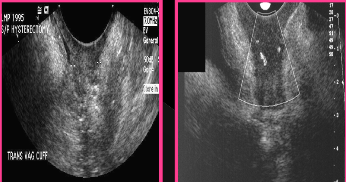 <p>The normal measurement of a vaginal cuff is?</p>