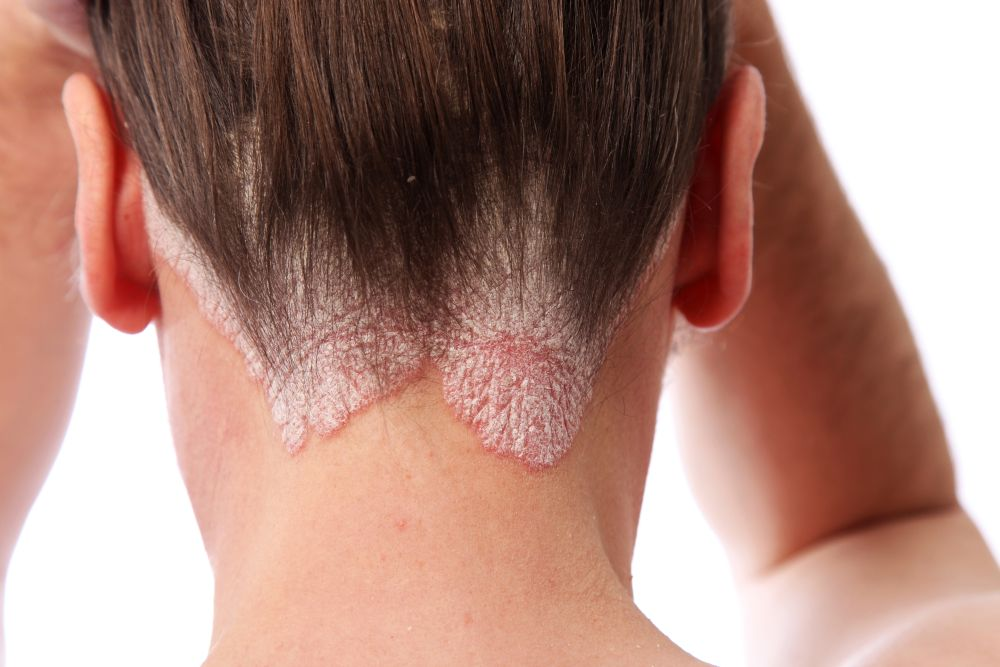 <p>PP: abnormal inflammatory reaction to malassezia in sebum-rich areas</p><p>E: malassezia<br>sebum rich areas<br>-scalp<br>-central face</p><p>CM: greasy scale on erythematous base<br>dandruff<br>peds: “cradle cap”<br>POC: lighter in color+no redness</p><p>TX:<br><u>peds:</u><br>NP: reassurance<br>outgrow by 6 months</p><p>MX: aquaphor<br>coconut oil</p><p><u>adults:</u><br>short term: hydrocortisone cream<br>long term: ketoconazole cream</p>