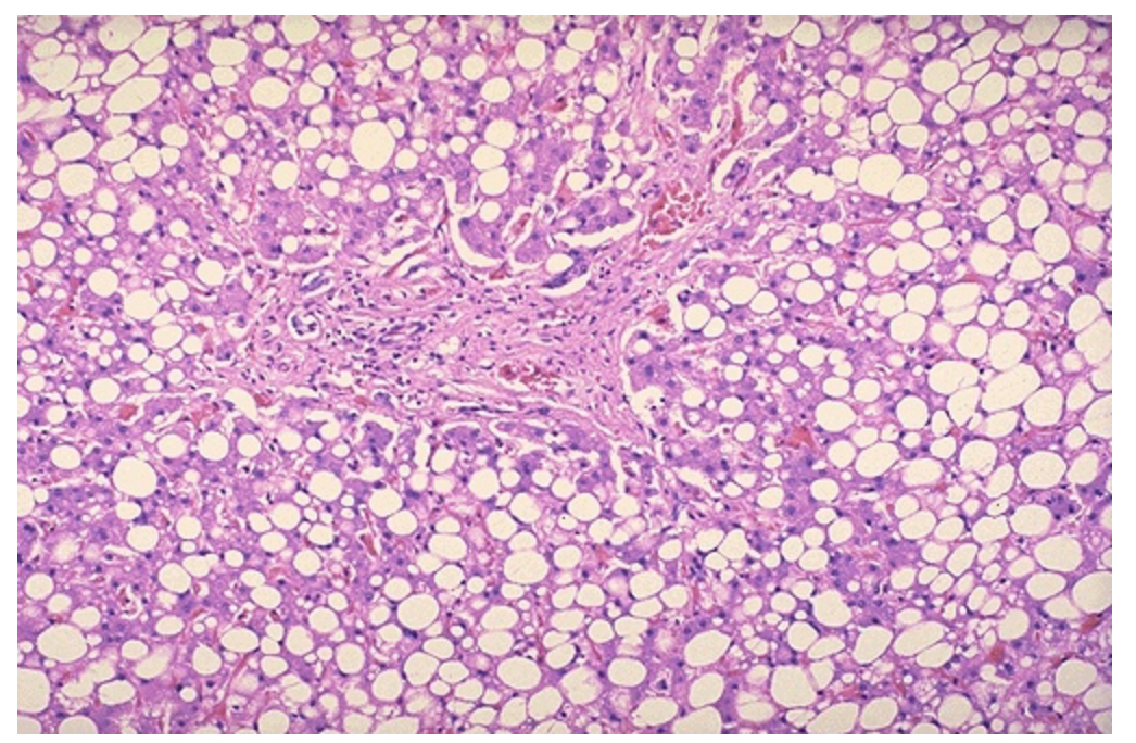 <p>Histological view of the liver full of white or clear droplets. Identify type of intracellular accumulation. Identify the condition and the causes of this condition.</p>