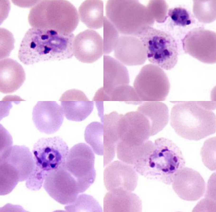 <p>Name: Plasmodium ovale</p><p class="p1">Stage: schizont</p><p class="p1">*schizont (stage where the parasite divided) contains many merozoites (purple bodies)</p><p class="p1">*<span><span>Schüffner’s dots</span></span></p>