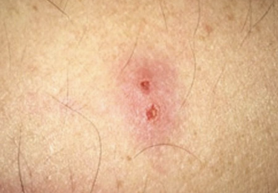 <p>single bite with two fang marks</p><p>(refer if black widow or brown recluse spider bites)</p>