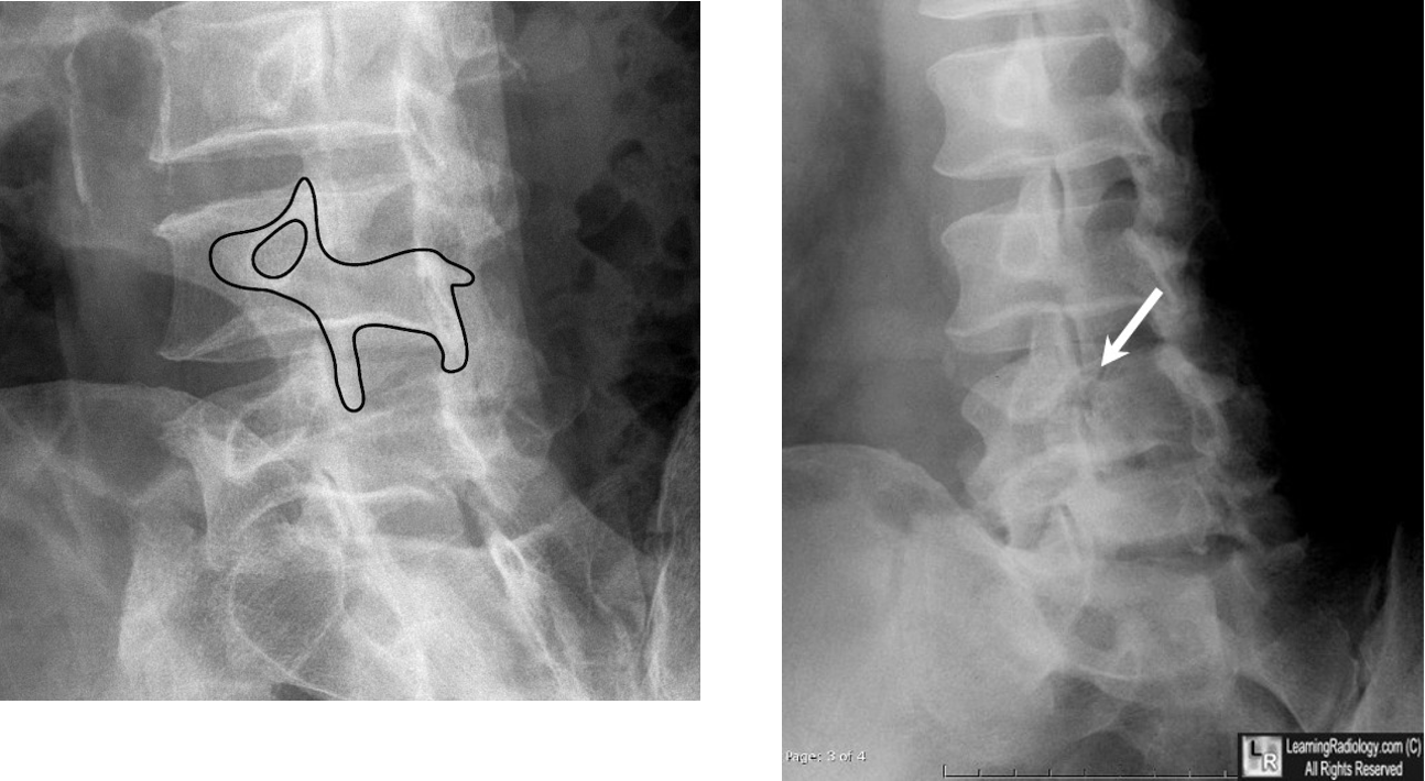 <p>fracture of pars interarticularis (sponylolysis) </p><p>(collar on scottie dog)</p>