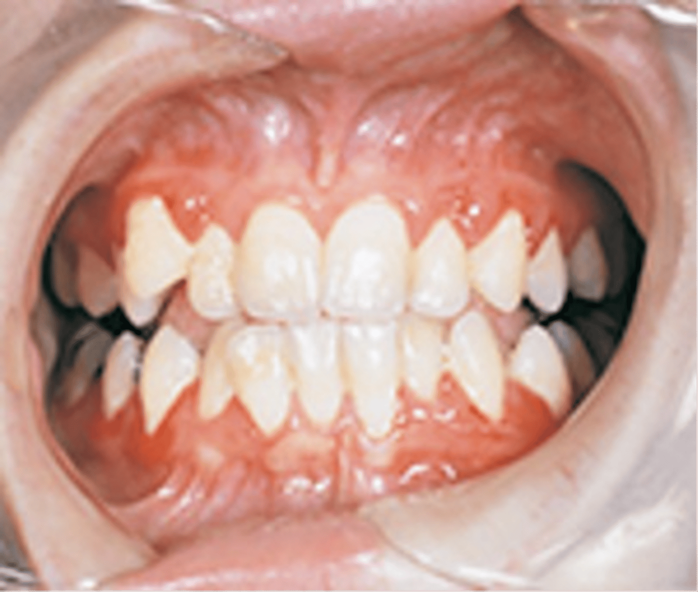 <p>ulcerated gingivitis is characterized by a decrease in the number of circulating neutrophilic leukocytes</p>