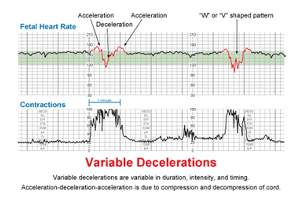 <p>Absence of accelerations or presence of sporadic repeated decelerations of FHR</p>