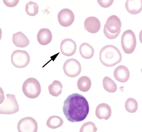<p>what is this an example of (*hint: look at central pallor)?</p>