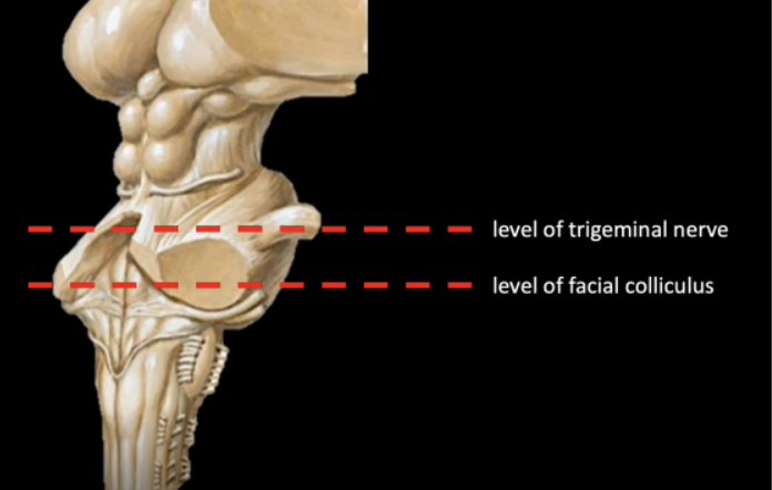 <ul><li><p>level of the Trigeminal nerve (CN V)</p></li><li><p>level of the Facial colliculus</p></li></ul><p></p>