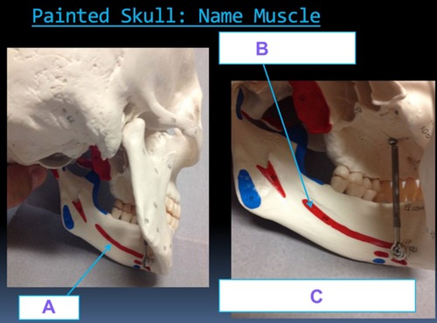 <p>#36 insertion</p>