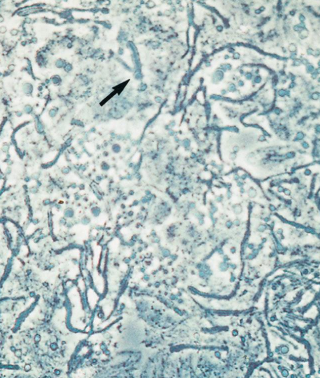 <p>Microscopic examination of skin scrapings from characteristic lesions in a potassium hydroxide (KOH) preparation or by observing yellow fluorescence with wood lamp on examination of the infected body site. Requires lipids for growth and will not grow on routine fungal media that have not been supplemented with a lipid source.</p>
