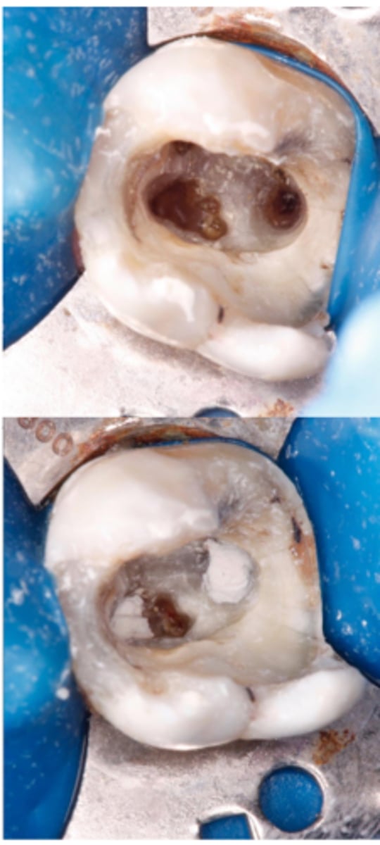 <p>What does this show on the tooth?</p>