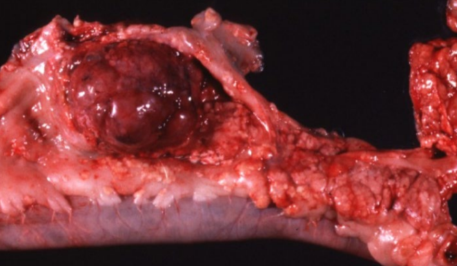 <p>Tissue from a dog. Presented with anorexia, vomiting, depression, and a fever. Abdominal ultrasound revealed a cranial abdominal mass. Morphologic diagnoses for the exocrine pancreatic mass? What is the expected biological behaviour of this mass? </p>