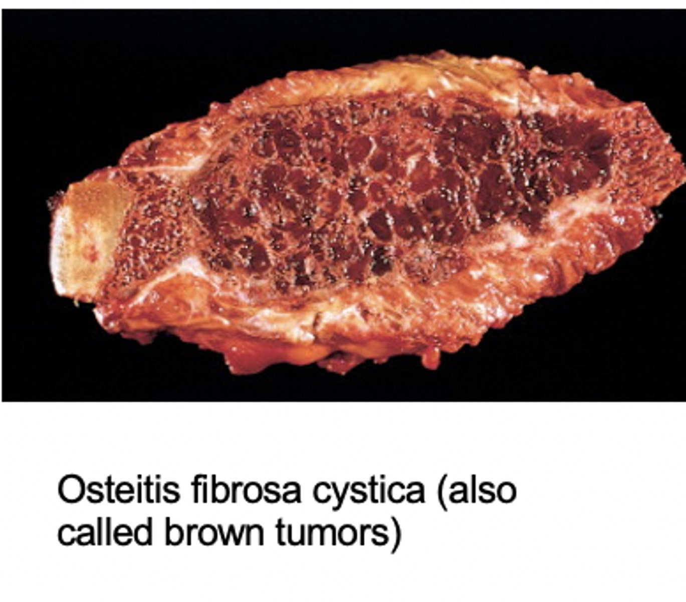 <p>lytic lesions due to high PTH levels (brown due to hemorrhage)</p>