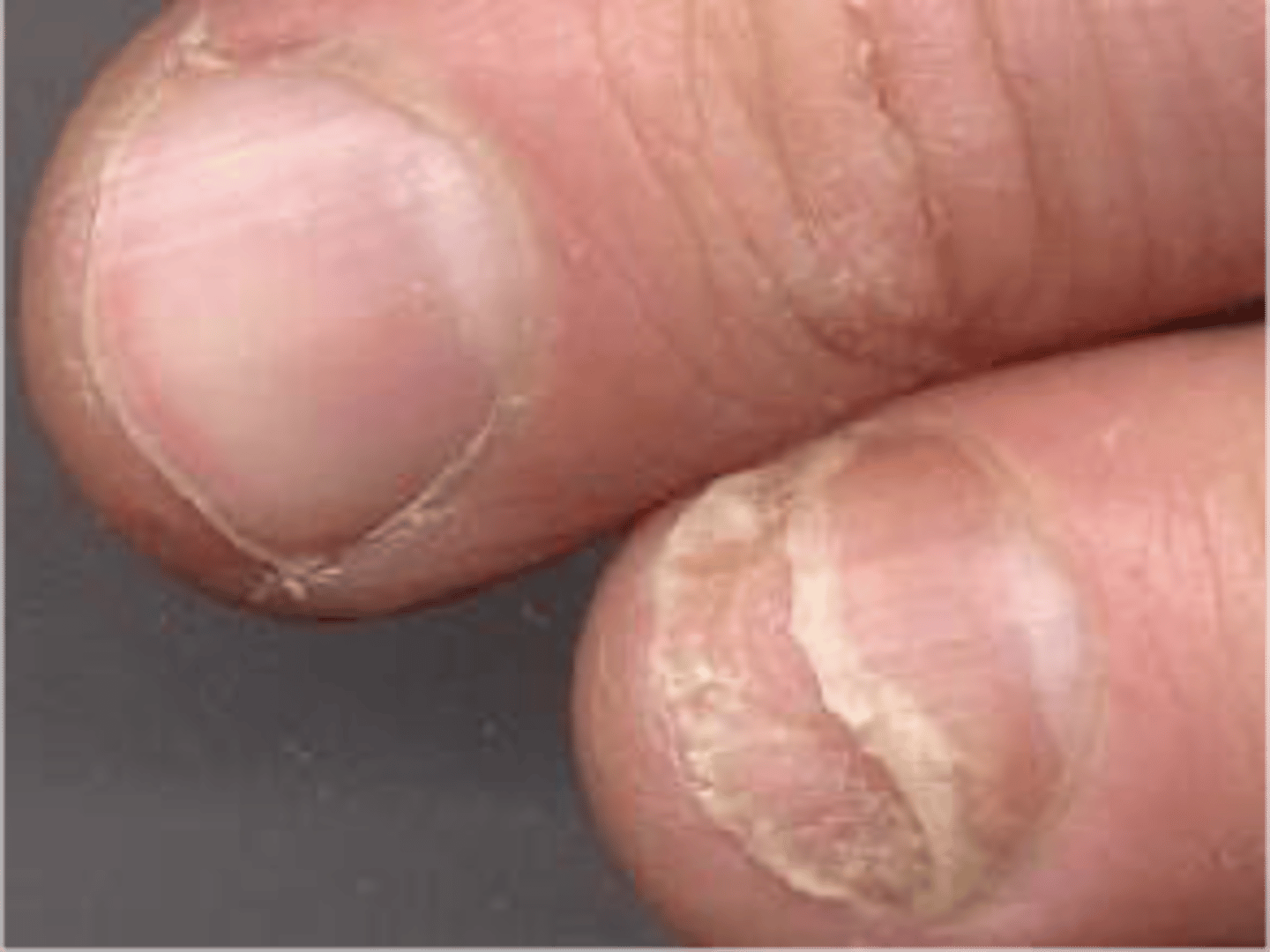 <p>name nail abnormality</p>