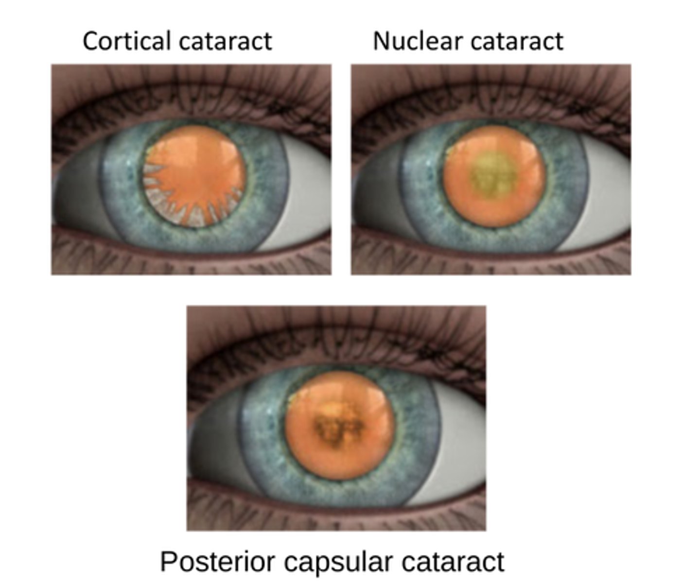 <p>-lens opaciﬁcation, results from aggregation of crystallins</p><p>-light scattering due to an accumulation of aggregates greater than 1000 angstroms in size.</p><p>-may be gradual or sudden with opacities in both the nucleus (inner region) and/or the cortex (outer region) of the lens.</p><p>-senile (age related)</p>