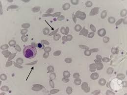 <p>Identify these types of red cells.</p>