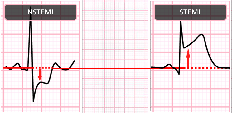 <p>infarct: tissue damage </p><p>ST depression</p>