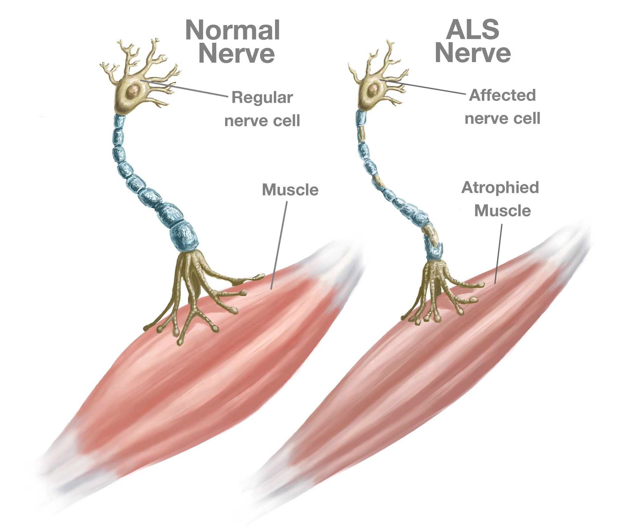 <p>A genetic disorder that causes muscle weakness and muscle atrophy. The motor neuron system breaks down which eventually causes paralysis. Physical therapy can help. </p>