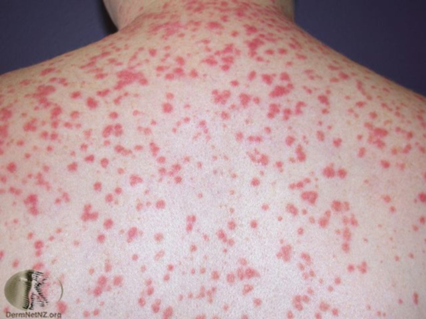 <p>diagnose this image:</p><p>this is presents as multiple small, drop-like scaly plaques that are usually <1 cm and appear abruptly</p>