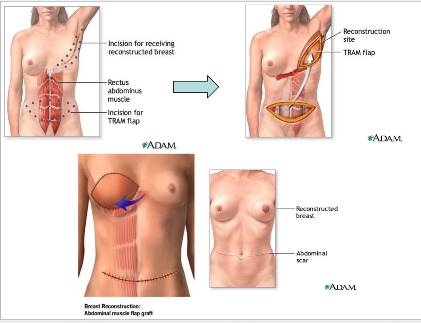 <p>Using the patient’s <strong>own skin, fat, and muscle</strong> from another body area to create a breast mound.<br>Common types:</p><ul><li><p><strong>TRAM flap</strong> — tissue from the <strong>abdomen</strong></p></li><li><p><strong>Latissimus dorsi flap</strong> — tissue from the <strong>upper back</strong></p></li></ul><p></p>