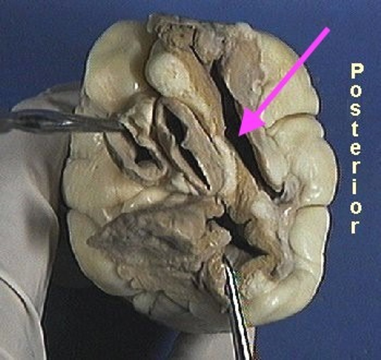 <p>Identify the blood vessel that carries blood from the head, neck, and arms of the body to the right atrium.</p>