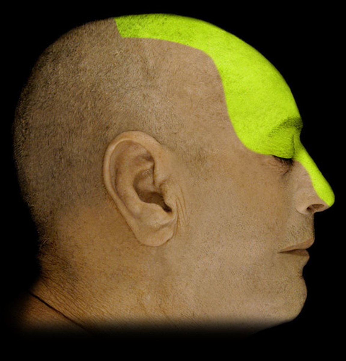 <p>general sensory in forehead region</p>